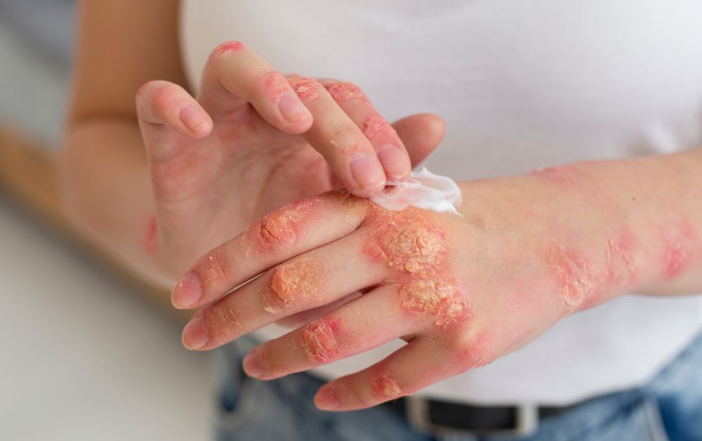 Skin Allergy